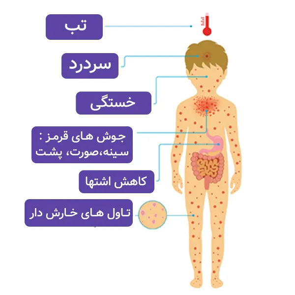 علائم آبله مرغان کودکان