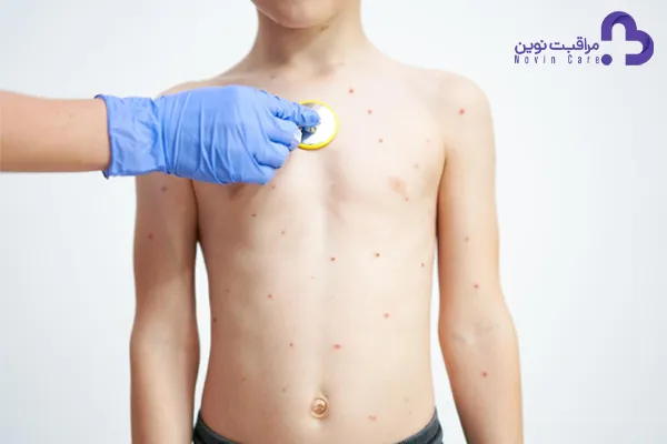 علائم و درمان آبله مرغان کودکان : ( نکات ضروری آبله مرغان ) 4 آبله مرغان در کودکان 1