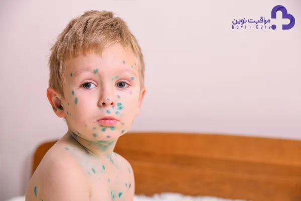 علائم و درمان آبله مرغان کودکان : ( نکات ضروری آبله مرغان ) 5 آبله مرغان کودکان
