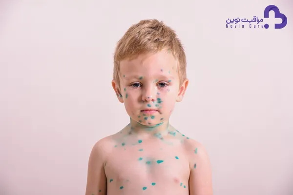 علائم و درمان آبله مرغان کودکان : ( نکات ضروری آبله مرغان ) 10 آبله مرغان کودکان