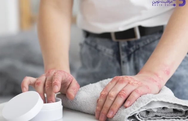 اگزما چیست؟ 6 اگزما چیست؟