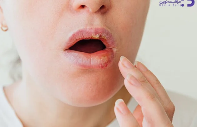 علت تبخال لب 4 علت تبخال لب